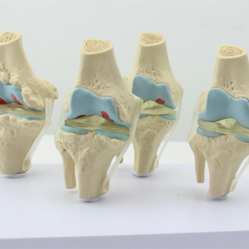 ENOVO颐诺人体病理膝关节y模型退行性血友病模型骨科管骨骼模型膝