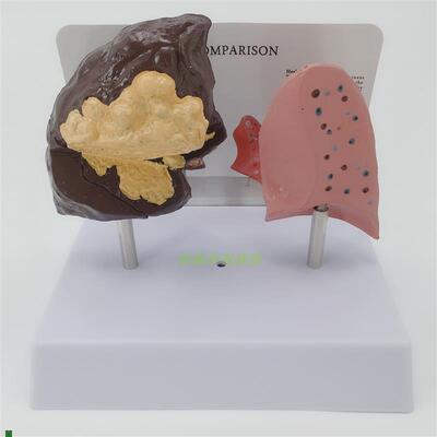 健康肺与病理肺比较模型正常病态肺脏对N比病理肺解剖切面模型