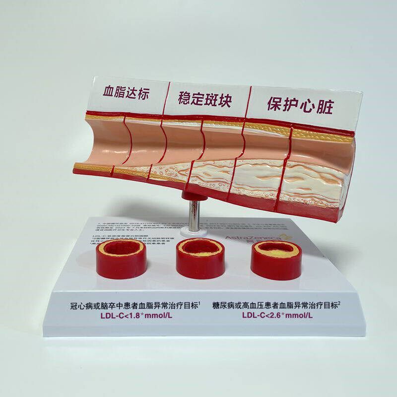 血管粥样脂肪斑块动脉内膜不同年龄段血管变化栓破裂狭Y窄堵塞病