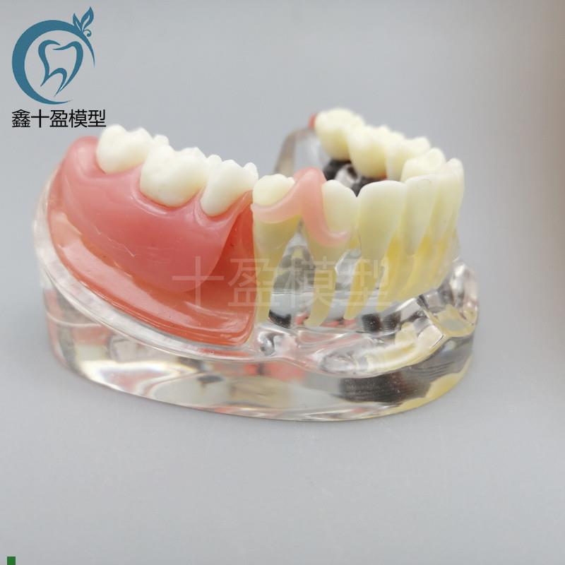 牙科口腔教学种植与修复模型3颗钉模型G微型种植医患沟通M6006