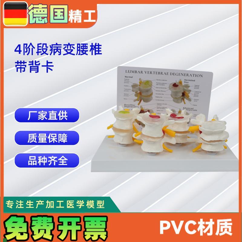 4阶段病态腰椎比较模型B带背卡骨科教学展示教具