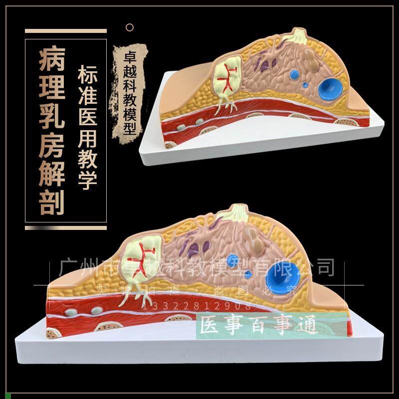 正品乳房常d见疾病模型乳房病理解剖结构模型乳房模型妇科模型