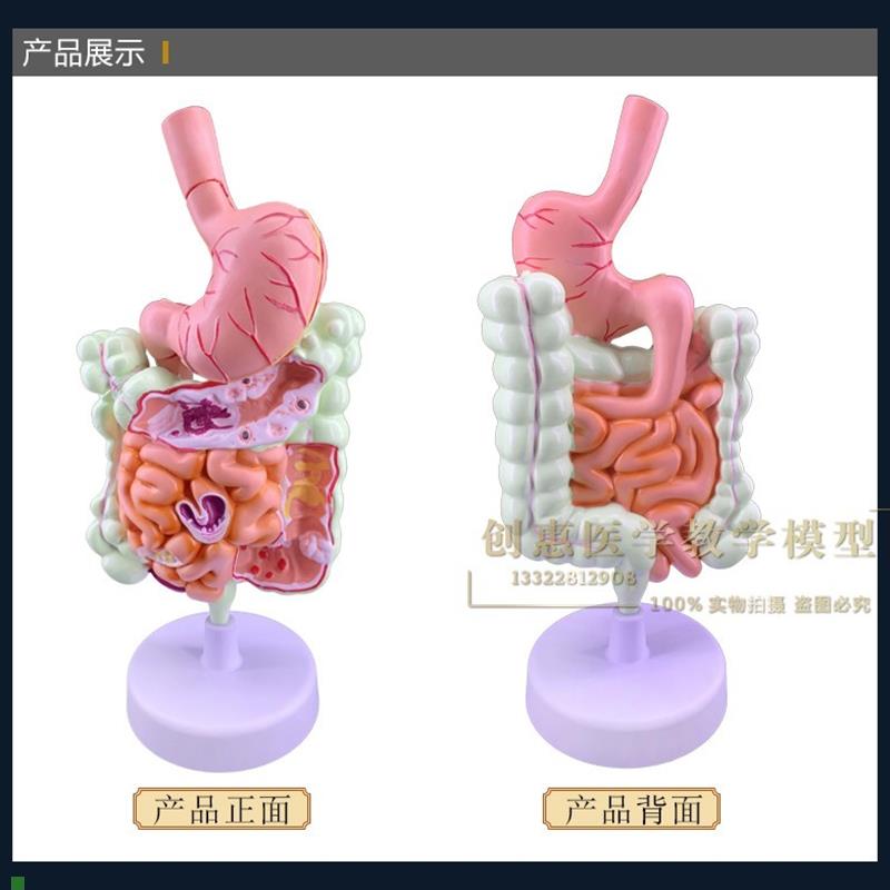 教学结肠病理模型大肠病变标本肠B道医患沟通交流人体器官解剖包