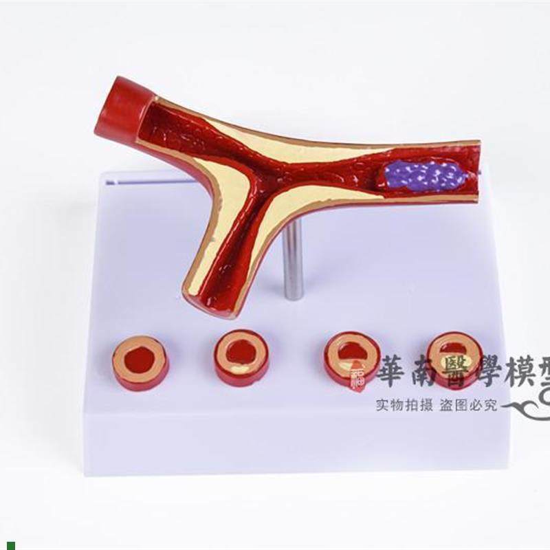 人体支脉粥样=硬化血栓=形成=模型血管模型血R液科动脉=化模型