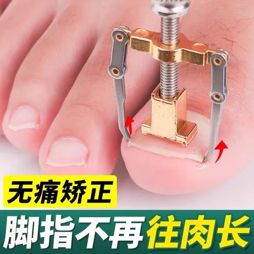 甲沟矫正器嵌甲矫正器卷甲纠正