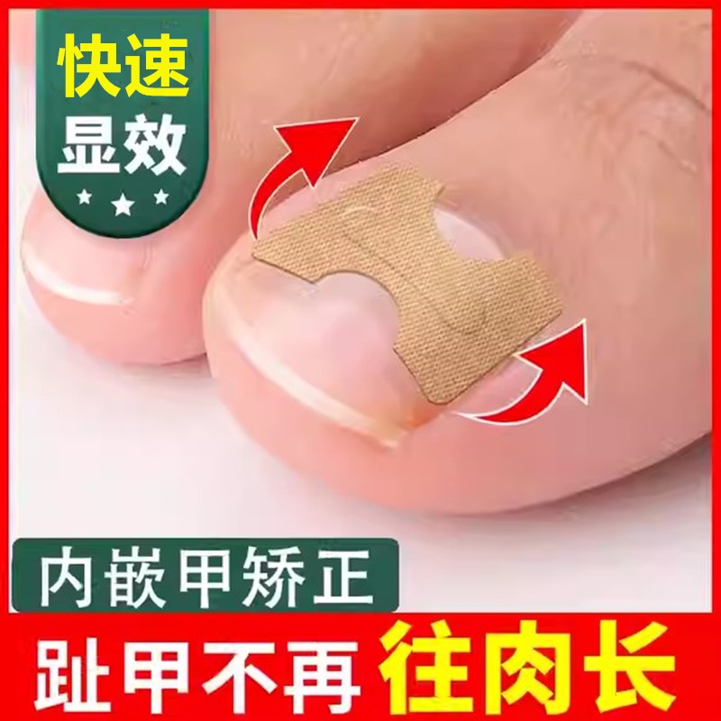 正甲贴沟嵌矫器炎脚趾片纠