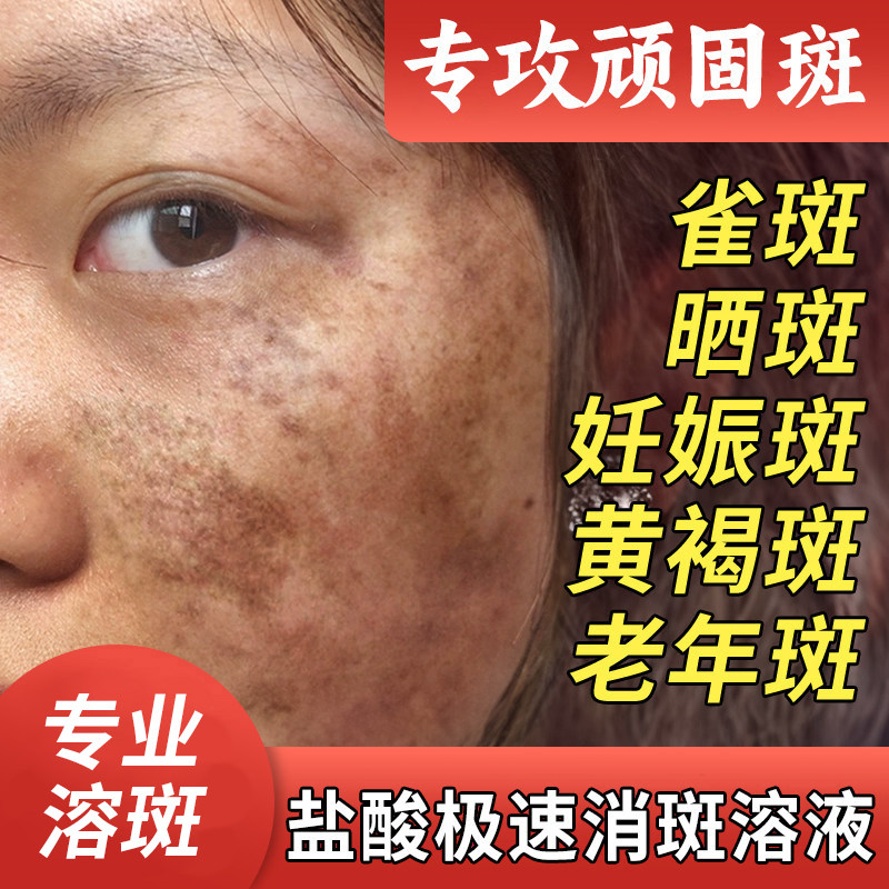 盐酸极速消斑溶液祛黑色班祛黄褐斑雀溶斑就掉精华液官方正品