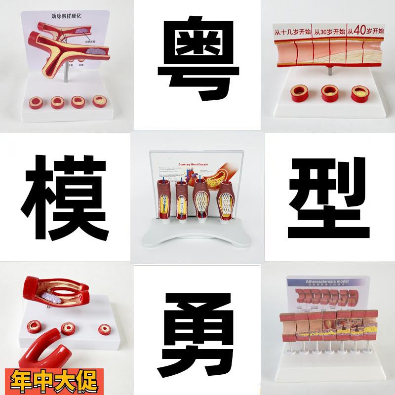 动态血管粘稠堵塞模型动支脉粥样硬化心血管支架放大病理教学模具