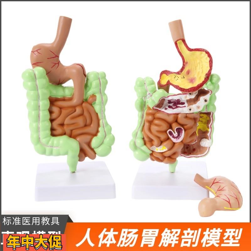 大肠病理模型肠胃模型大肠病变模型肠道疾病人体结肠病变模型