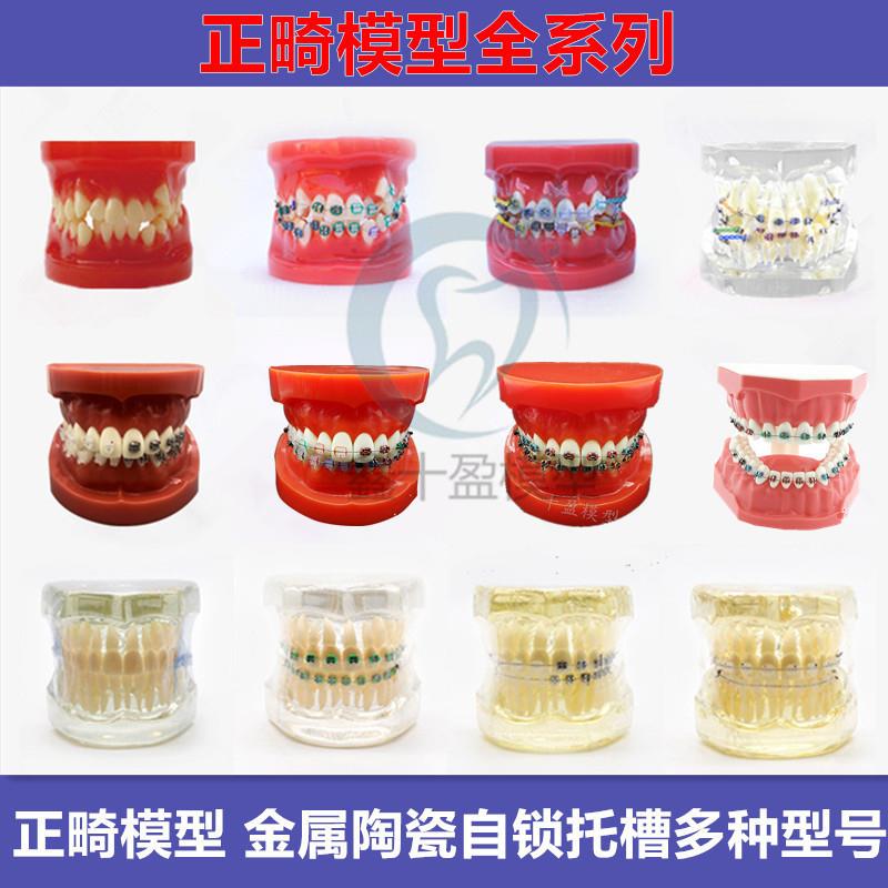牙科口腔4种托槽对比模型正畸陶瓷金属自锁托槽托槽示范模型包邮