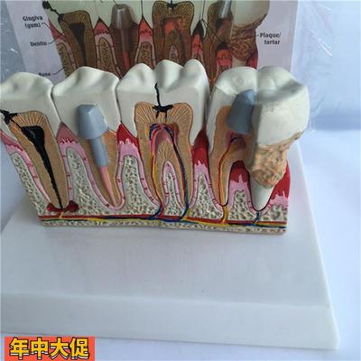 蛀牙虫牙牙齿牙病模型烤瓷冠牙牙龈炎牙周炎牙垢镶牙教仪厂家直销