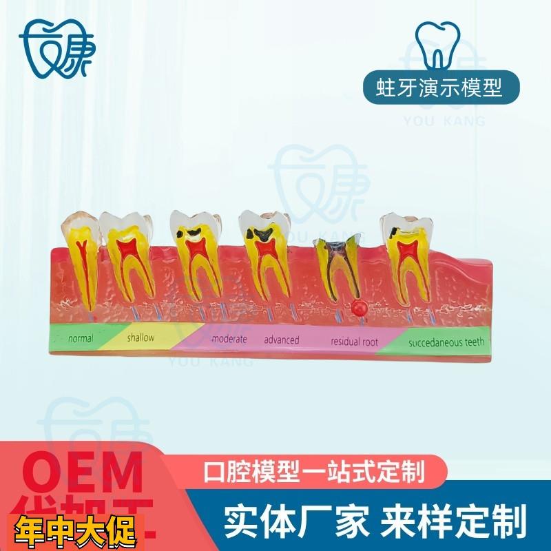 口腔教学模型牙科口腔牙科蛀牙模型蛀牙演示模型蛀牙龋齿模型