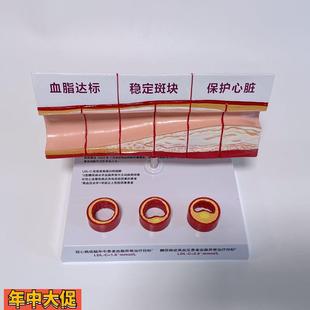 病理心血管模型粥样硬化脂肪斑块动脉内膜受损程度医药促销礼品