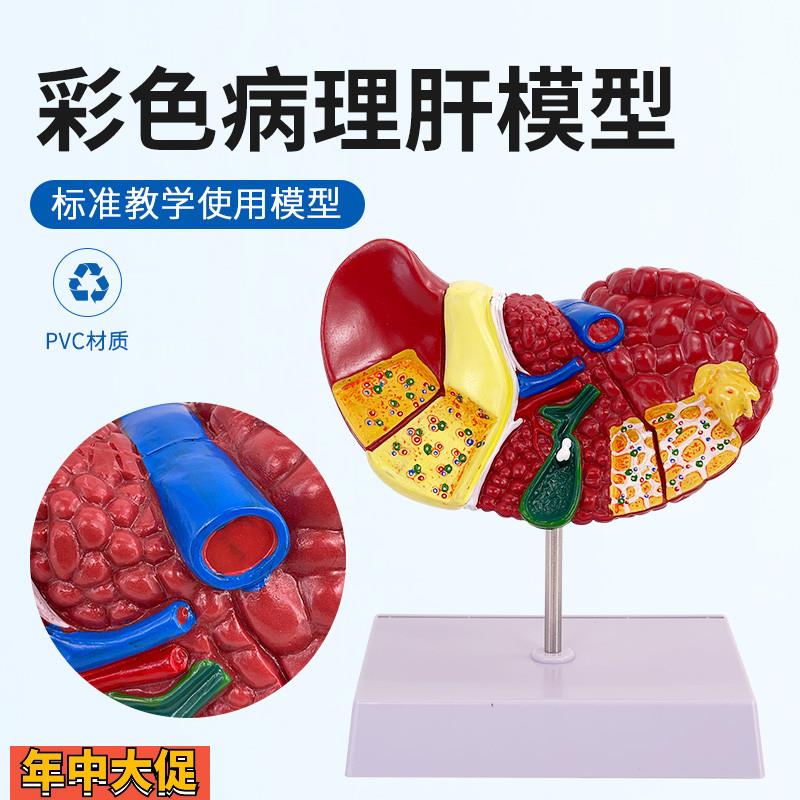 彩色肝脏模型常见临床病理特征医生用医患沟通硬化脂肪炎肝胆内科
