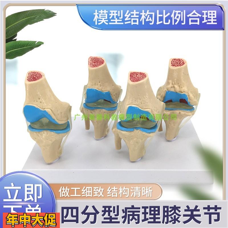 病变膝关节模型退行性关节人体膝关节功能模型半月板交叉韧带髌骨