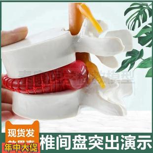 椎间盘压迫神经演示模型突出脊骨劳损骨质密度变化疏松变脆老年骨