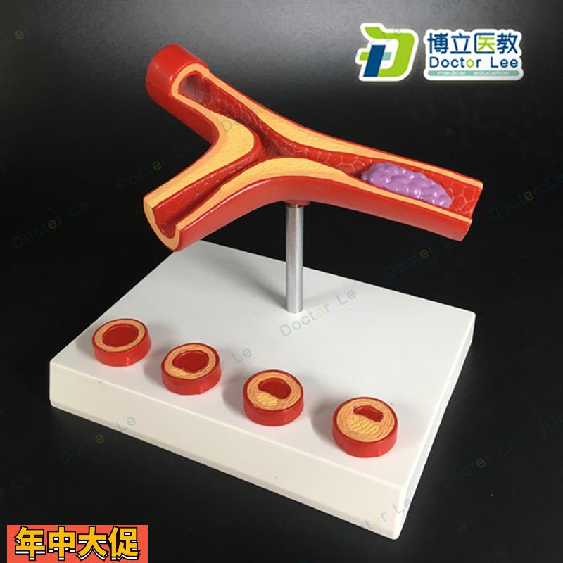 血管堵4塞血液浓度脂肪病理血液血管粥样血管病理解剖模型
