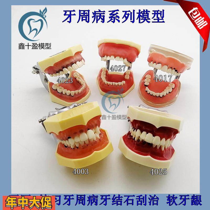 牙科口腔教学模型牙周病理模型练习刮治结石牙周分类医患沟通