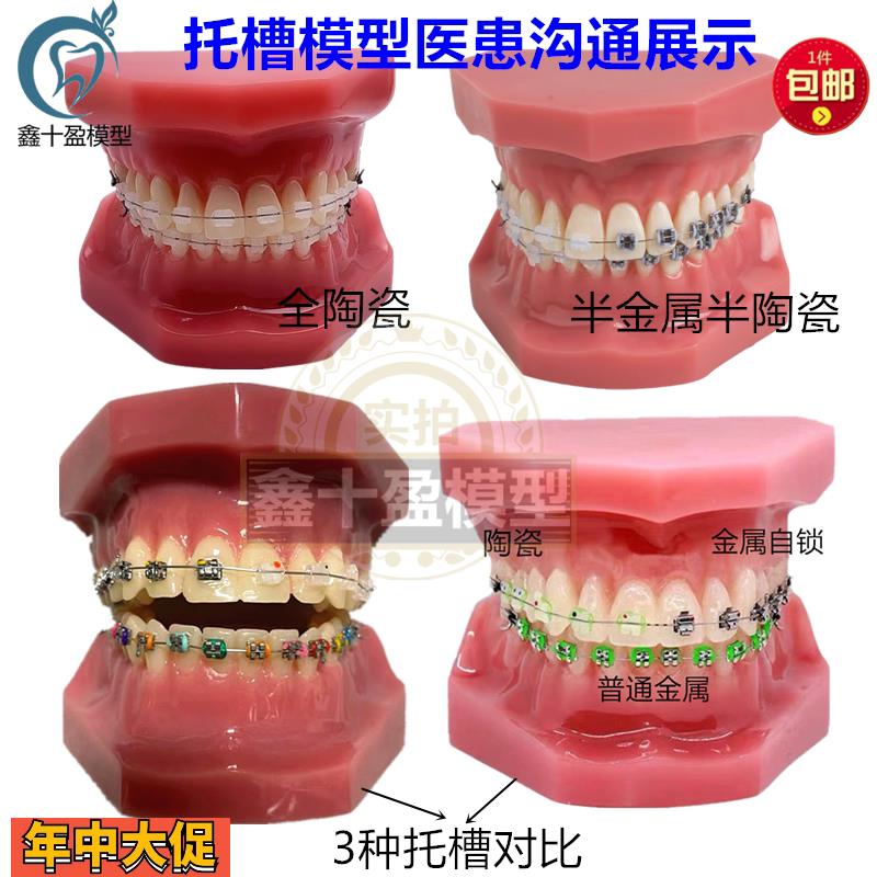 牙科正畸模型全口陶瓷金属自锁红色正畸医患沟通矫正练习托槽