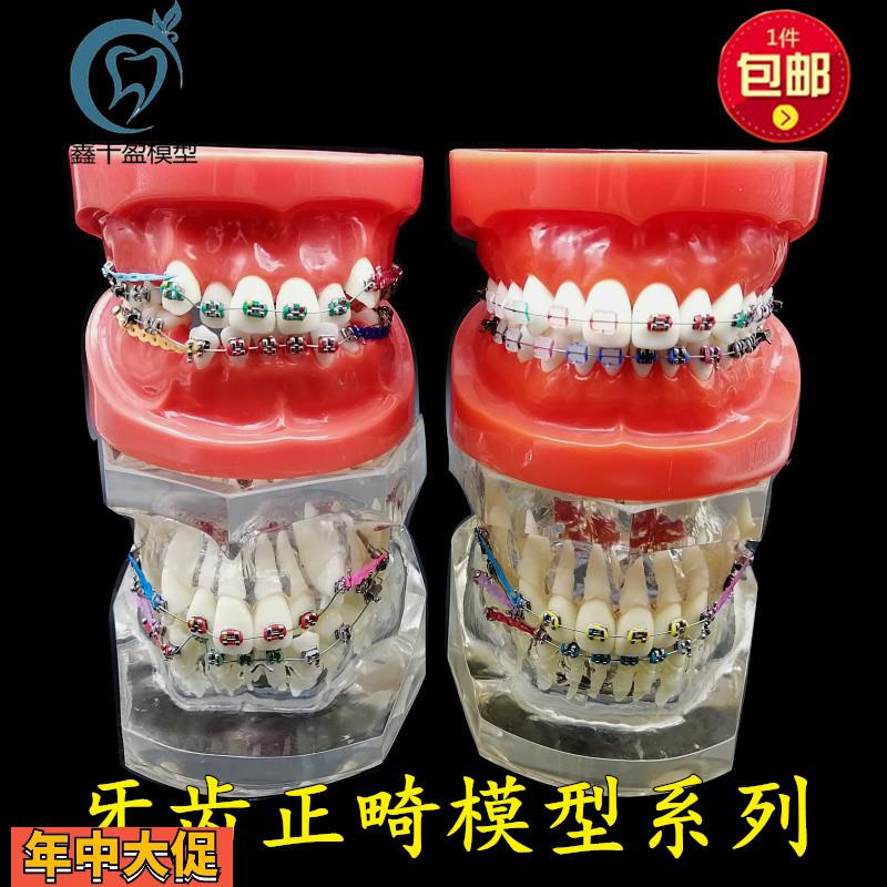 牙科正畸模型透明错颌矫正展示模型结扎丝托槽正畸带支抗钉牙列