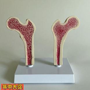 骨质疏松模型股骨头骨髓密度变化骨科医药促销年龄段脊椎病理医患