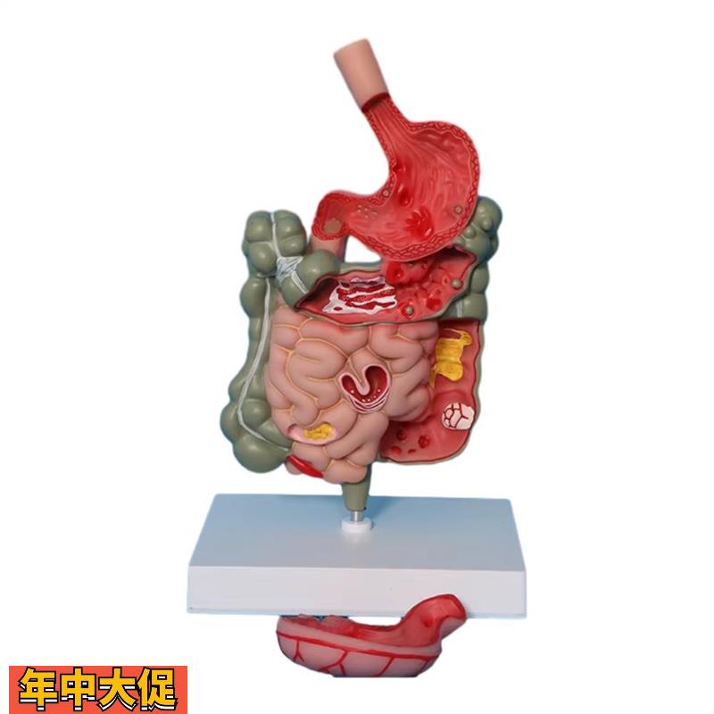 大肠病理模型人体结肠病变模型肠胃模型大肠病变模型肠道疾病