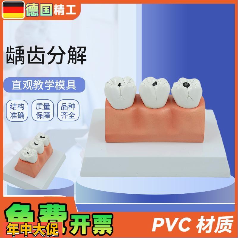 德国】龋齿病分解解剖模型牙齿模型口腔牙保健护理模型牙科牙齿