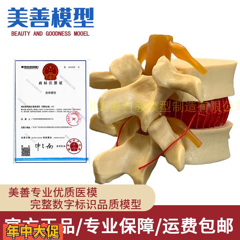 脊柱模型脊椎骨头腰椎间盘模具椎体模型突出受压病理骨质教具