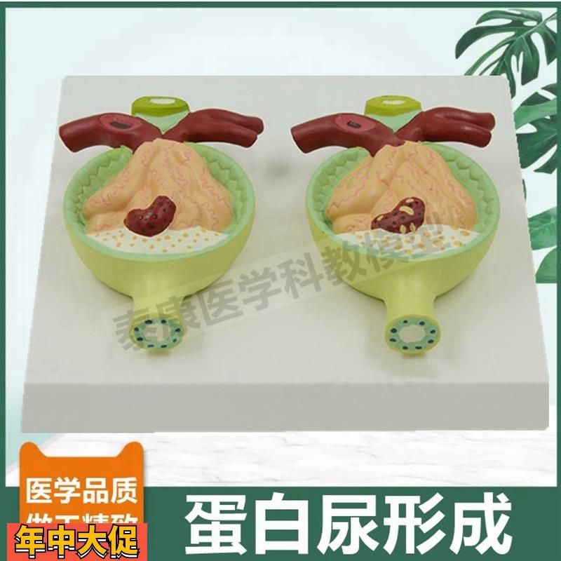 尿蛋白模型病理肾脏肾小球肾单位肾上腺病肾泌尿器官内分泌医患用