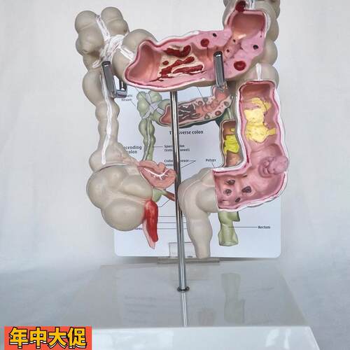 包邮人体结肠直肠病变模型肠器官医用教学讲解病理展示