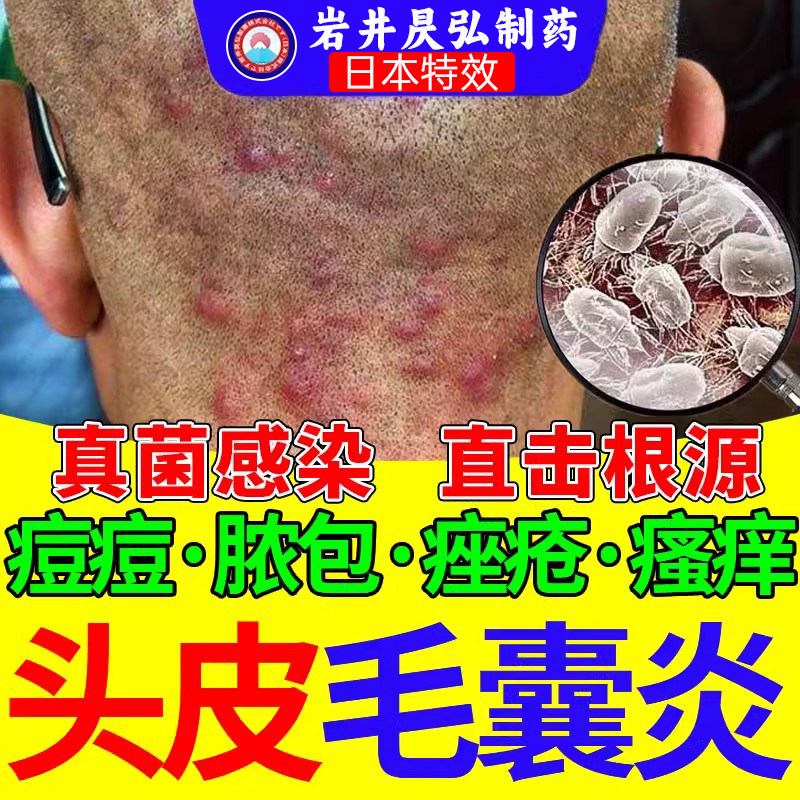 毛囊炎特效头部头痒头皮头上有红疙瘩后背长痘痘专用沐浴露软膏,保健用品,皮肤消毒护理（消）,淘宝优惠券,粉丝福利购,淘宝优惠卷