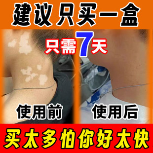 白风癜外用快速消白斑专用补骨脂酊风特效黑色素生长软膏遮盖神器