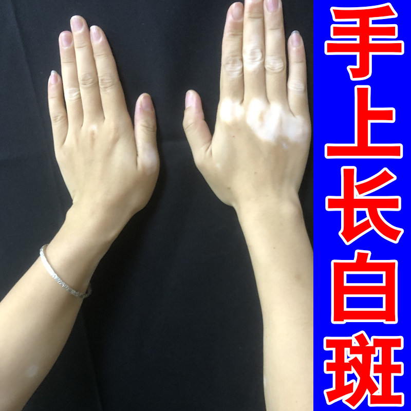 冶身上多处淡白斑胳膊浅色白点躯干色素不均印记手背肤色变浅斑块