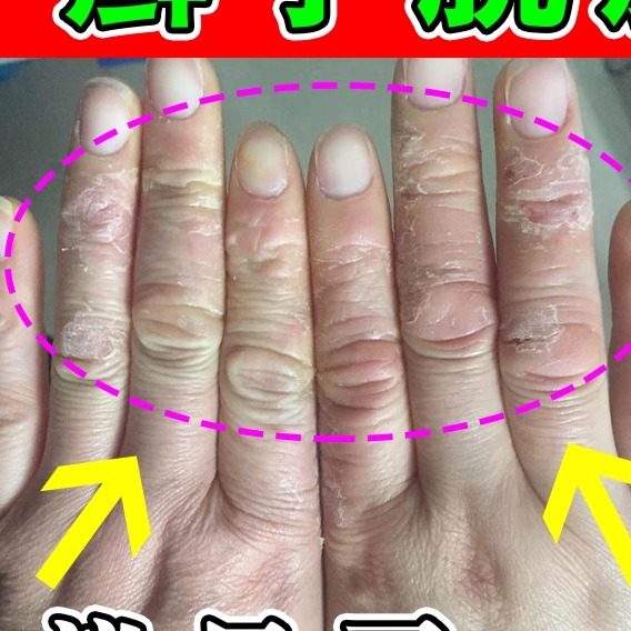 手药专用膏冶鹅掌风足湿痒真菌感染手指关节起小水泡