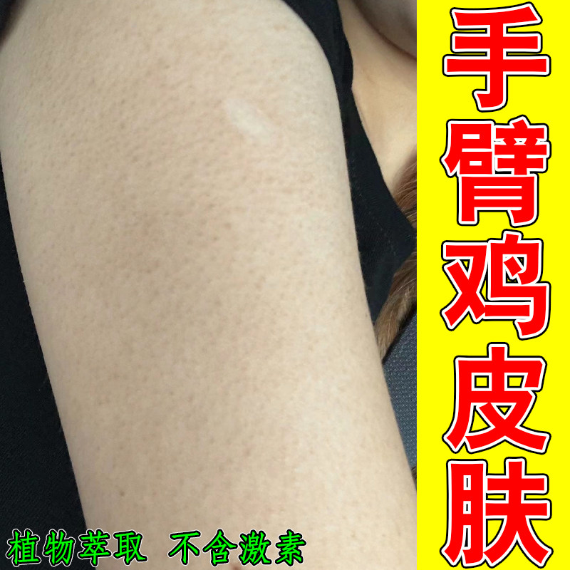手臂鸡皮疙瘩胳膊上起小颗粒痘痘皮肤消毒护理（消）