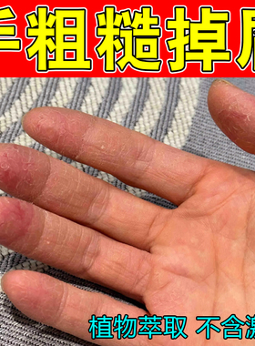 手粗糙掉屑干裂口手背痒脚后跟干燥角质层增厚手上长小水泡修护药