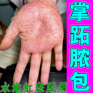 掌跖脓包症皮肤干燥起硬皮手掌角化症红斑水泡疙瘩粗糙开裂干痒