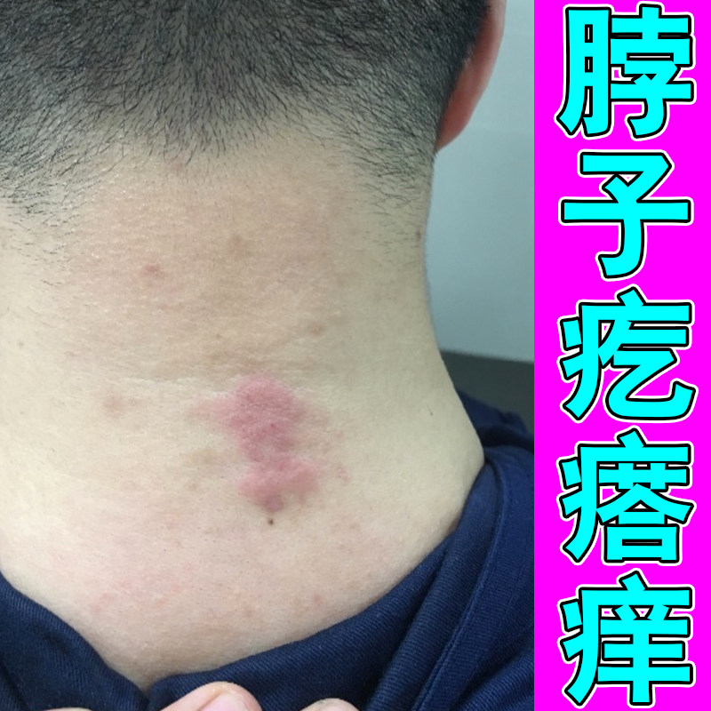 脖子疙瘩痒起皮红肿掉屑紫外线过敏神经性天热晒红肿痒颈部刺挠痒