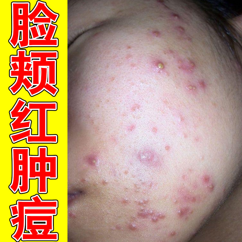 脸颊红肿痘去闭口粉刺脸上长痘下皮肤消毒护理（消）