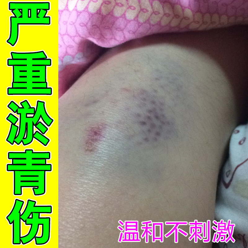 大小腿磕碰后青紫色斑块肌肤透出暗色印记无撞击长出青块皮下乌青