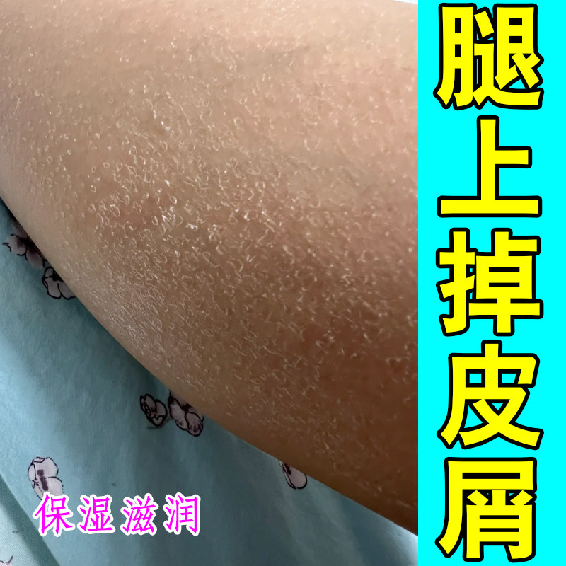 腿上鱼鳞专用干燥掉皮屑脱皮痒小腿皮肤痒保湿补水修复药毛囊角化