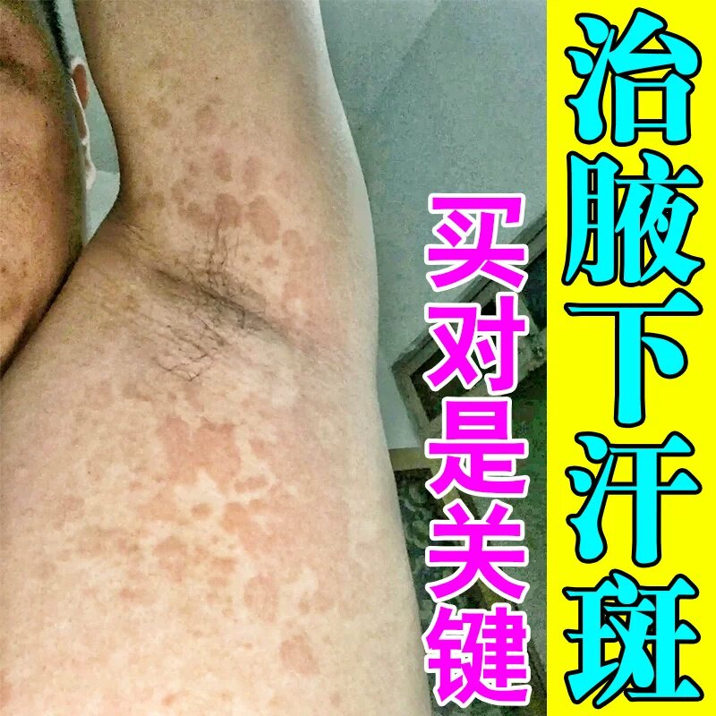 腋下汗斑花斑专用腋窝皮肤发痒快速消白斑黄褐色斑糠疹