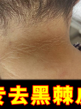 去脖子色素沉淀去脖子变白神器脖子肘关节专用去除分解素