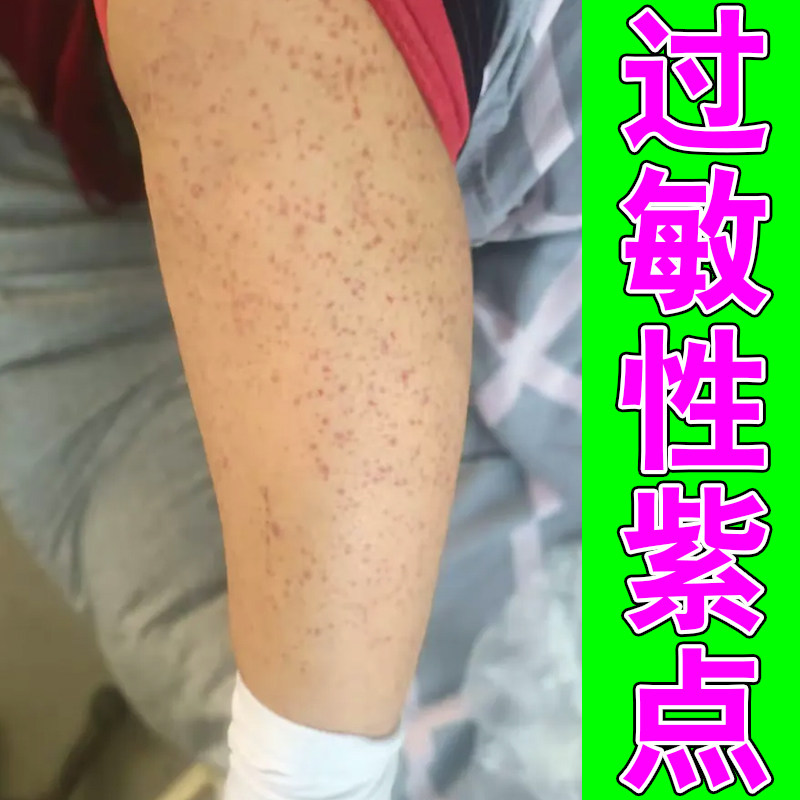 冶小腿出现紫褐色瘀点肢体散在红紫斑块身上莫名皮下印记四肢肌肤