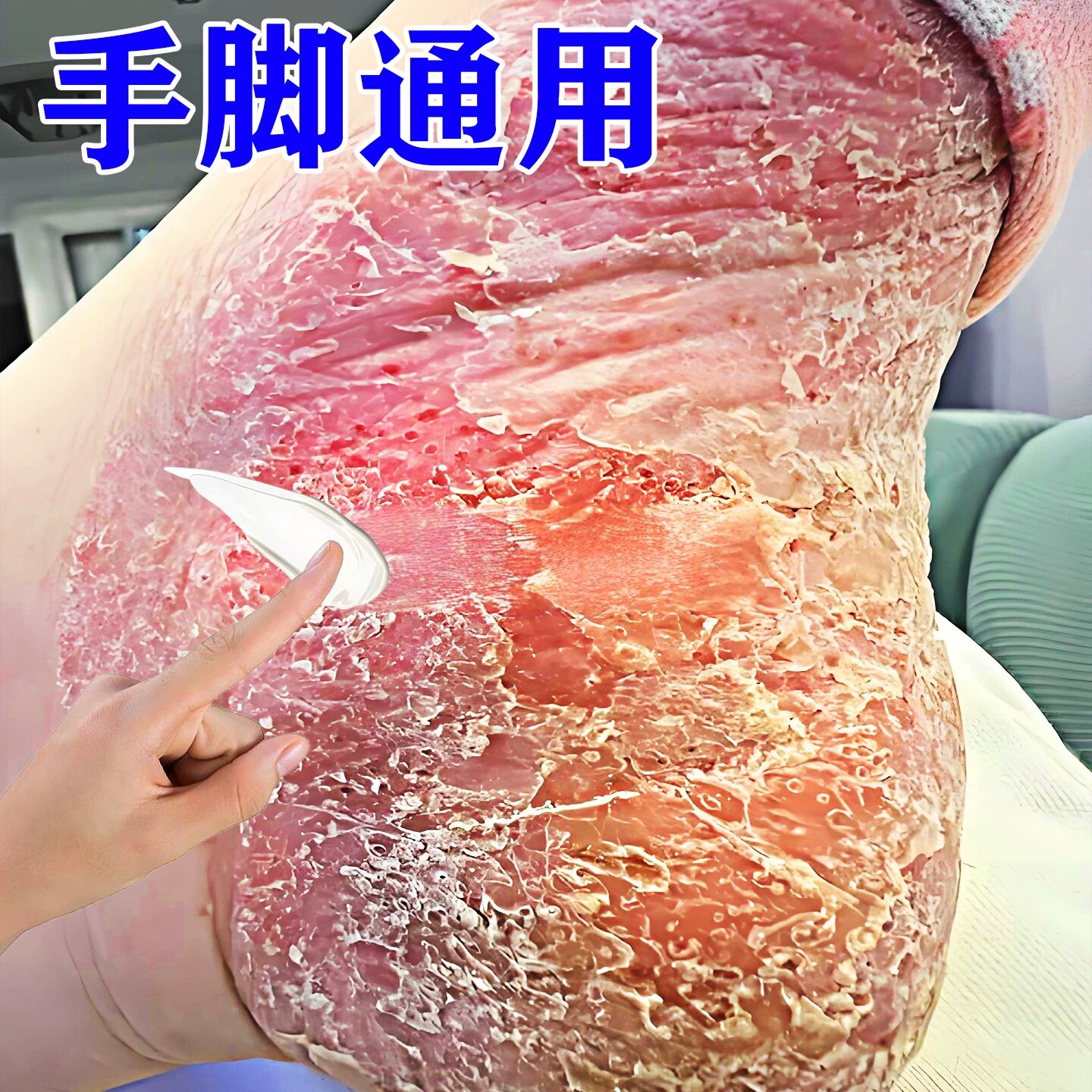 掌趾ii疱专用症药掌跖角化症手脚脓包红斑干裂脱皮粗糙外膏