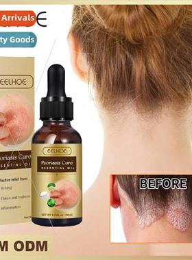 Skin Moss Repair Essential Oil Relieve Itchy Skin Stop Itchy