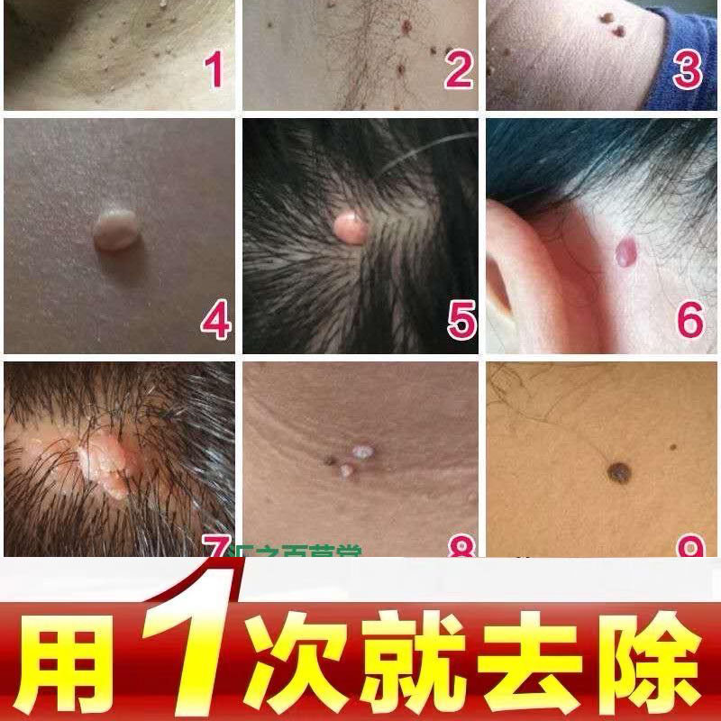 祛刺猴疣治净手上膏神器的药去除猴子肉粒疙瘩手部正品瘊子鱼鳞痣