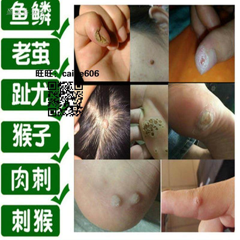 猴子疣,皮肤猴子疣(第10页)_大山谷图库