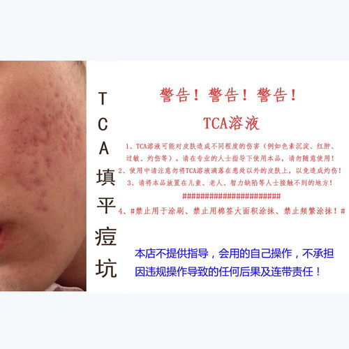 tca溶液三氯乙酸浅层换肤35%浓度