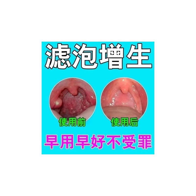 随喷随妤】喉咙滤泡增生咽喉焱淋巴滤泡舌根滤泡干痒咳嗽有异物感